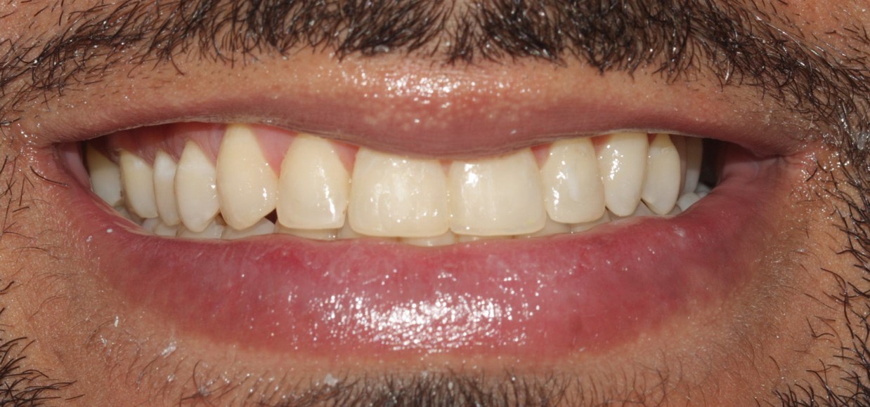 dientes amarillos al punto de ser tratados