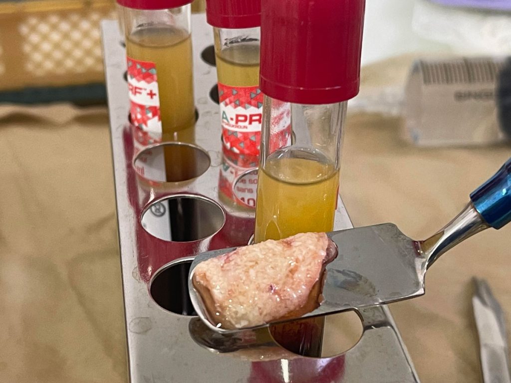 A-PRF y Sticky Bone: aplicaciones avanzadas en regeneración ósea y cirugía oral