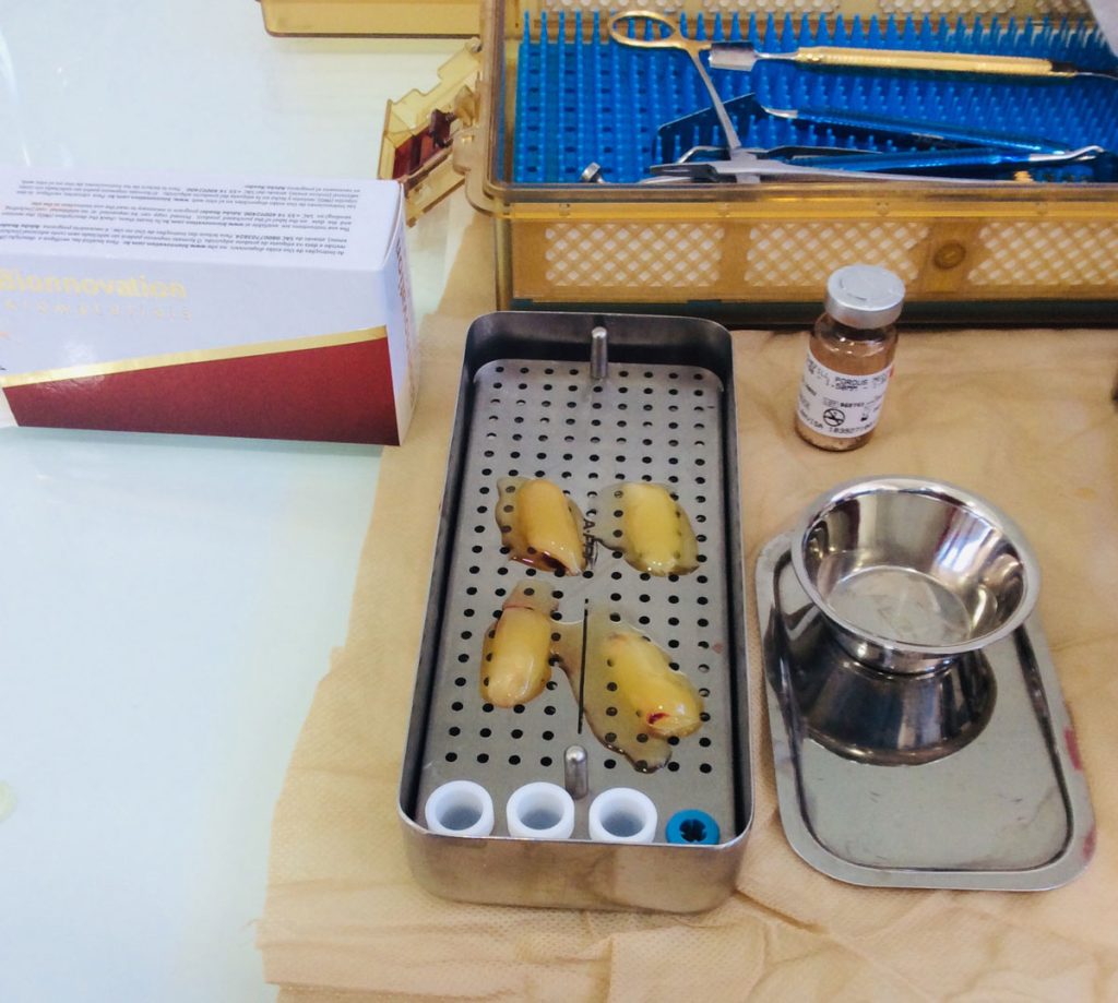 ¿Qué es la A-PRF y para qué se usa?