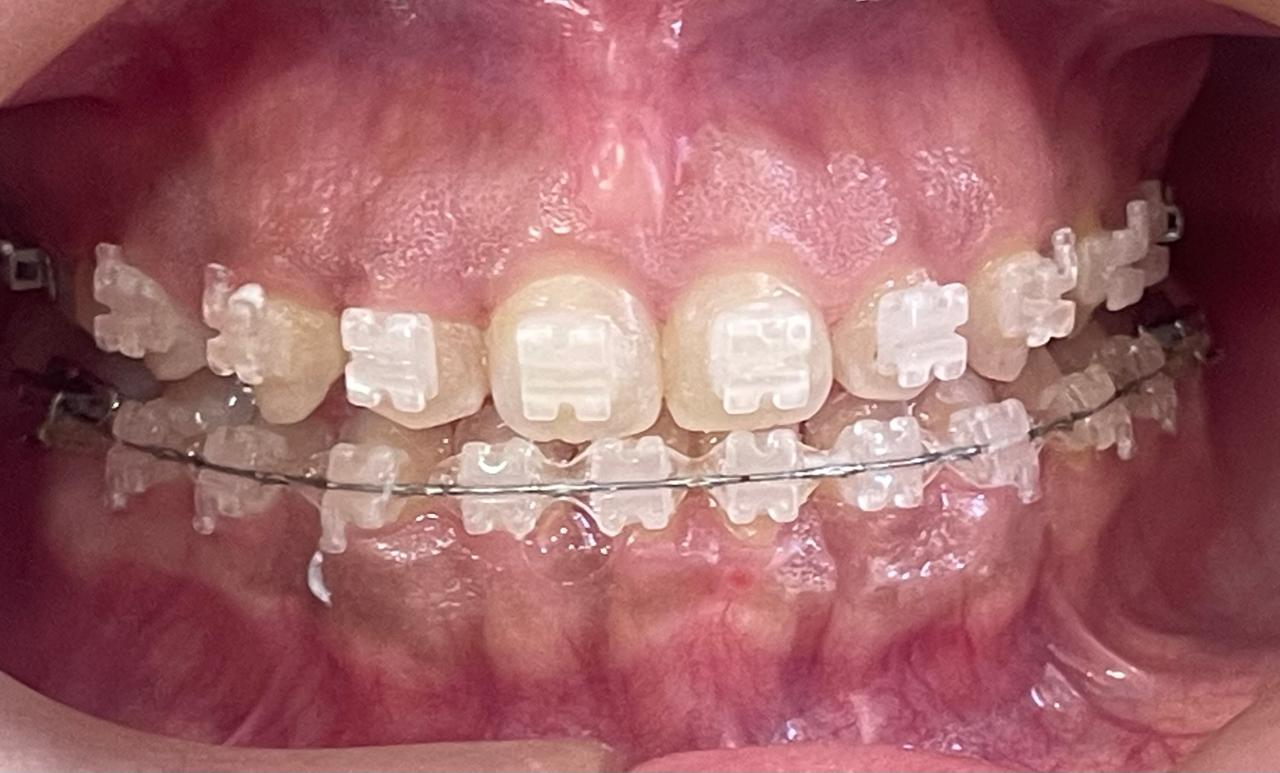 innodes_antes_zolar_dental_laser