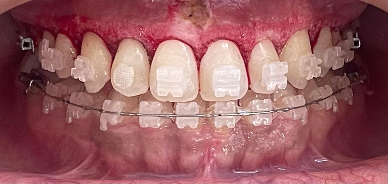 innodes_despues_zolar_dental_laser