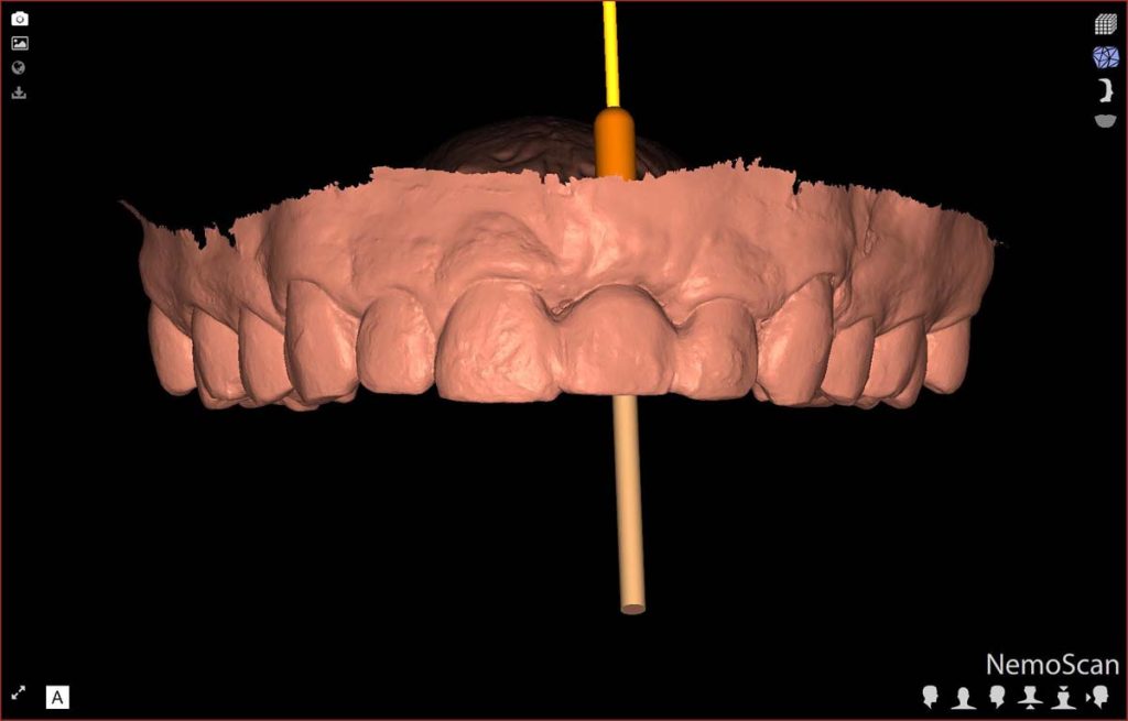 Planificación Digital de Implantes: precisión, seguridad y resultados predecibles